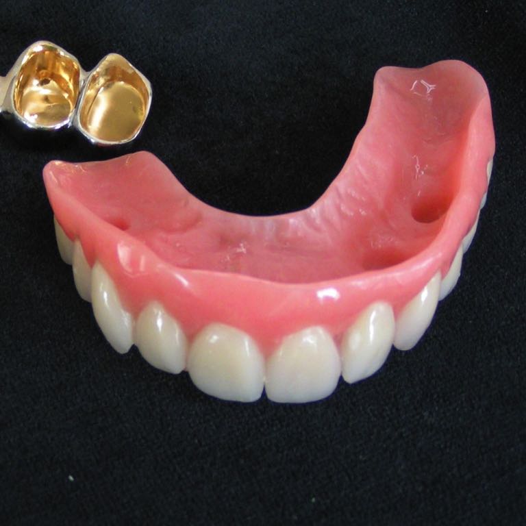 Abnehmbare Brücke inkl. Provisorium(2)