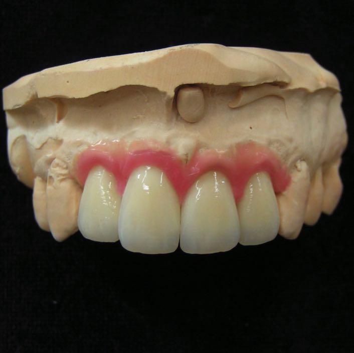 Vollkeramik Zirkon 2 auf 2