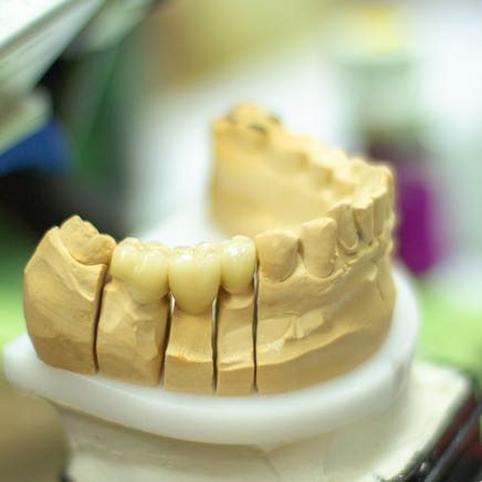 tooth-replacement-3532981_1920